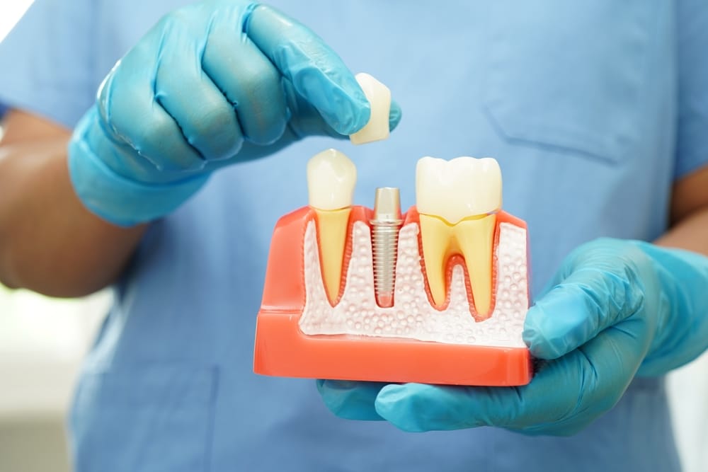A durable, long-term solution for replacing missing teeth and restoring full function.